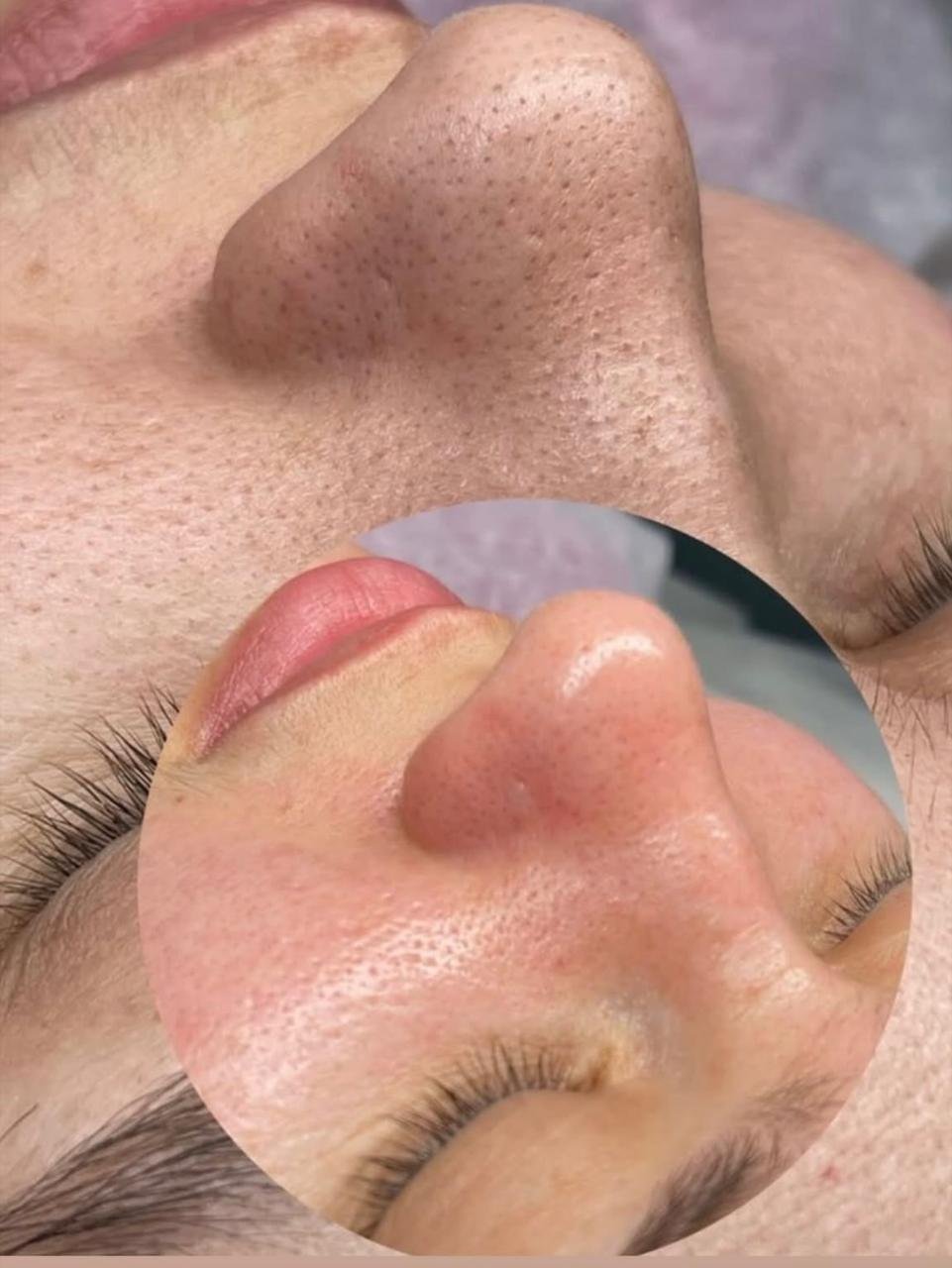 Ulthérapie - Avant et Après