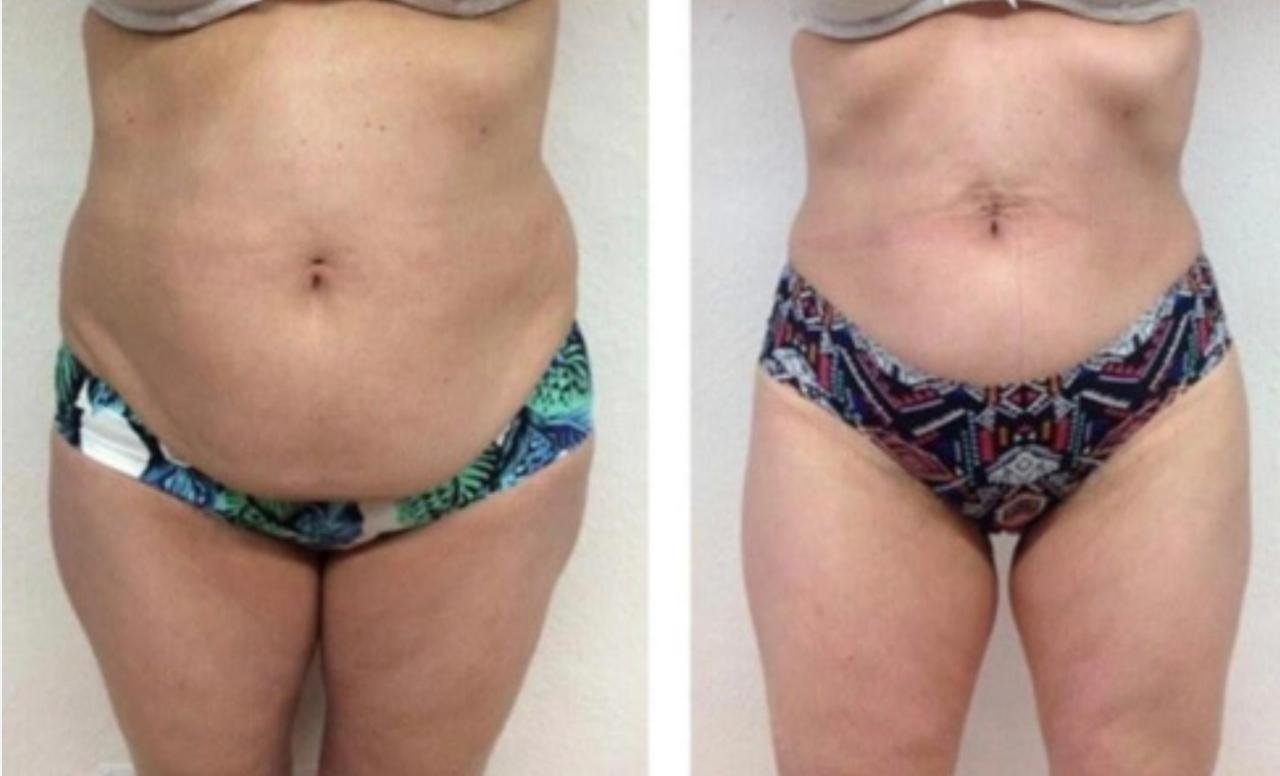 Embellir les lèvres - Avant et Après