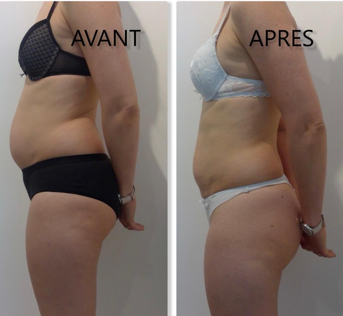 Effacer les rides du front - Avant et Après